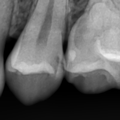 [을지로/치과] 하얀색 이맥스 인레이 세라믹인레이 / 실제 케이스/ 비용 가격 알려드려요 관련 이미지 5