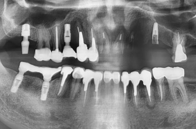 충정로 서울역 근처 고난도 & 재수술 임플란트 수술 치과 관련 이미지 3