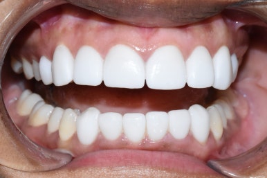 아주 하얀 치아를 만들고 싶어요 라미네이트케이스 및 비용 안내 관련 이미지 3