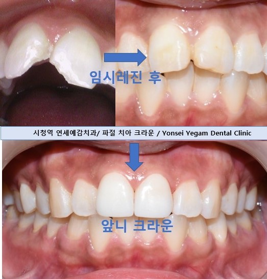 [광화문/연세예감치과] 앞니 치아가 파절되었다면? 앞니 부러짐.레진/크라운/임플란트 관련 이미지 9