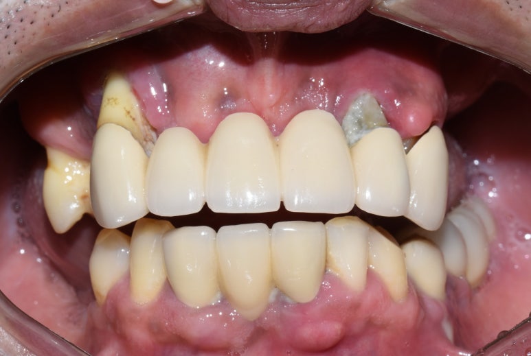 사용중인 틀니가 불편하다면? 임플란트와 틀니가 결합된 임플란트 틀니 추천 관련 이미지 3