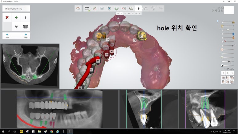 [남대문시장] 임플란트 조금 더 안아프고 간편하게 관련 이미지 15