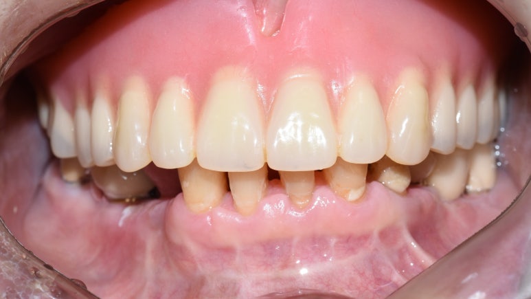 사용중인 틀니가 불편하다면? 임플란트와 틀니가 결합된 임플란트 틀니 추천 관련 이미지 2