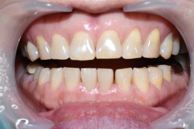 앞니사이벌어짐, 레진으로 메울 수 있을까? 비용,가격까지. 종로치과/광화문 치과 관련 이미지 1