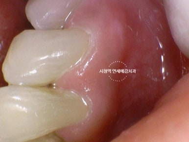 해외에서도 찾아오는 앞니레진치료, 광화문 시청역 서울역 근처 연세예감치과 외국인도 찾는 이유 관련 이미지 8