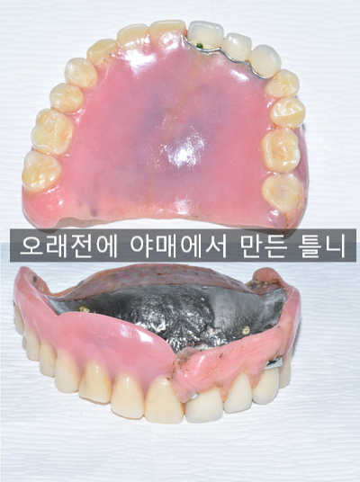 [종로/시청역]실제 환자의 보험 임플란트, 보험 틀니 사례 소개합니다. 젊어지는틀니,임플란트 치료 관련 이미지 2