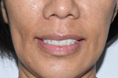 전체 임프란트를 하기 위해 홍콩에서 오신 홍콩인 환자분 관련 이미지 7