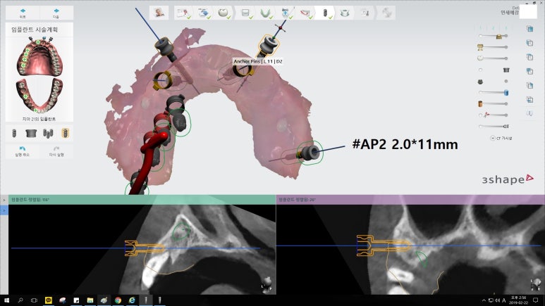 [남대문시장] 임플란트 조금 더 안아프고 간편하게 관련 이미지 6