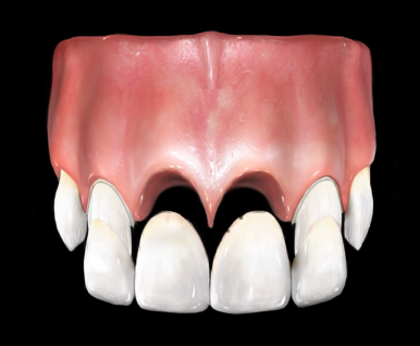넘어져서 또는 부딪혀서 앞니 아주 많이 부러진 경우, 시청역치과 실제 앞니브릿지케이스 관련 이미지 7