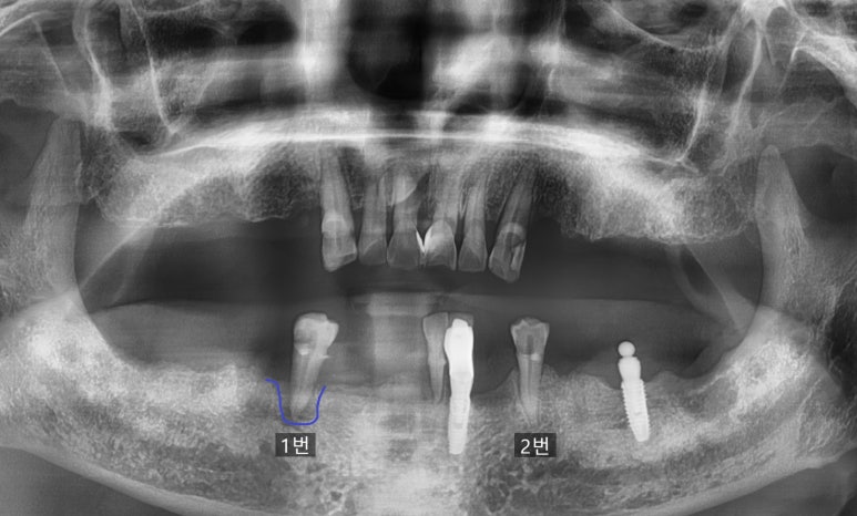 임플란트, 빼면서 바로 심을 수 있나요? (발치즉시 임플란트) 관련 이미지 1
