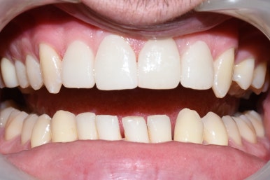 왜소치 치아사이틈 막기 올해는 치료받으세요! [무삭제라미네이트 케이스] 관련 이미지 6