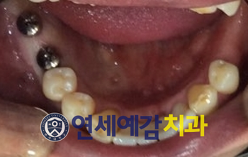 이가 빠졌어요. 이 빠진 환자 보철 환자 케이스 소개 <시청역 연세예감치과> 관련 이미지 7