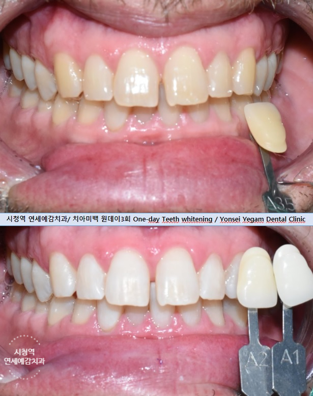서울역 치아미백 직접 미백제 공장 갔다온 미백에 진심인 원장님의 치과 [feat.외국인미백관광으로도 유명] 관련 이미지 2