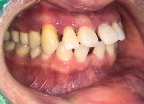 시청역치과 벌어진 앞니를 바르고 이쁘게! 대한심미학회회원치과 관련 이미지 5