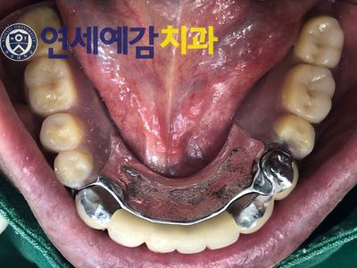 남대문시장&시청역가까운 치과/보험틀니 환자분 스토리 소개 관련 이미지 4