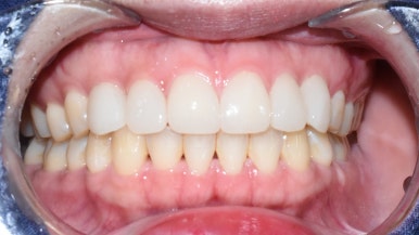 서울시청역치과/ 벌어진 앞니 치아 치료/ 왜소치, 다이아스테마 등/레진, 라미네이트, 부분교정 비교 관련 이미지 21