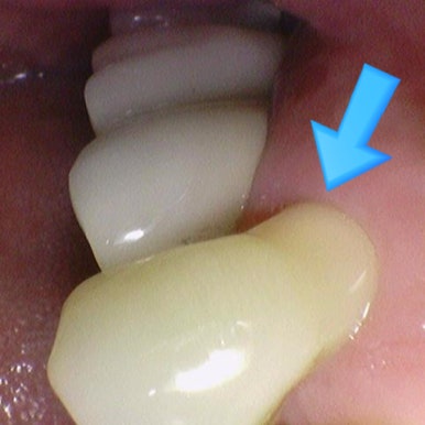 서울 충정로역 근처 치아패임, 잇몸패임. 어떻게 치료해야하나요? 관련 이미지 6