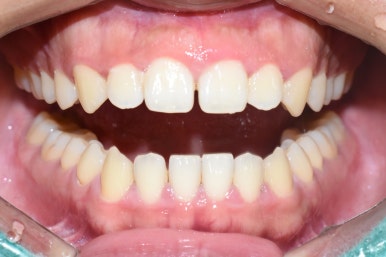 서울시청역치과/ 벌어진 앞니 치아 치료/ 왜소치, 다이아스테마 등/레진, 라미네이트, 부분교정 비교 관련 이미지 13