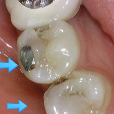 시청역 충정로 충치치료 치과 추천 관련 이미지 9
