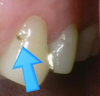 광화문 치료 치아에 까만 점이 생겼어요 관련 이미지 2