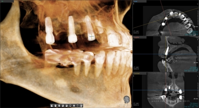 시청역,광화문 직장인에게 필요한 빠른 임플란트! 수술이 무서운 어르신들에게 만족도 높은 임플란트! 관련 이미지 5