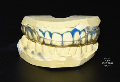 [시청역,서울역/치과] 개개인 맞춤형 치과제작 이갈이 장치로 이를 보호하세요& 비용,가격 정보 관련 이미지 4