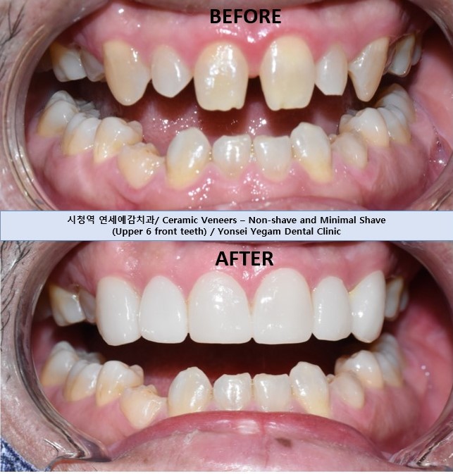 VENEER in Seoul, Korea/ Cost, Cases(before&after photos)/ YONSEI YEGAM DENTAL CLINIC 관련 이미지 2