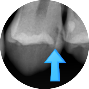 [서울시청역] 눈에 보이지 않는 충치 실제사진 관련 이미지 8