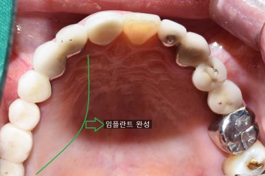 앞니 여러개 임플란트 잘하는 치과 서울역치과 실제사진 관련 이미지 4