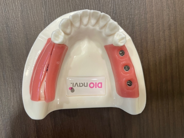 서대문역 가까운 치과 비절개 네비게이션임플란트 소개;덜아프게 빠른 회복위한 관련 이미지 4