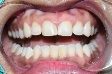 아주 하얀 치아를 만들고 싶어요 라미네이트케이스 및 비용 안내 관련 이미지 1