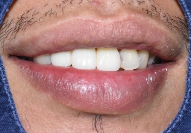 서울시청역 남대문 임플란트 대신에 앞니 브릿지를 한 케이스 관련 이미지 10