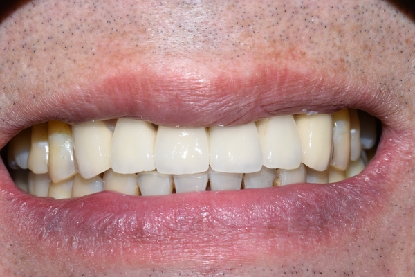 시청역 앞니교정 알아보겠습니다![실제 사례:앞니 하나가 점점 튀어나오고 벌어져요] 관련 이미지 4