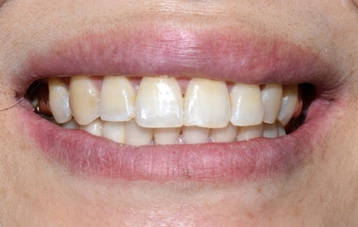 벌어진 앞니 교정치료 & 오래된 앞니 브릿지 다시하기 관련 이미지 12