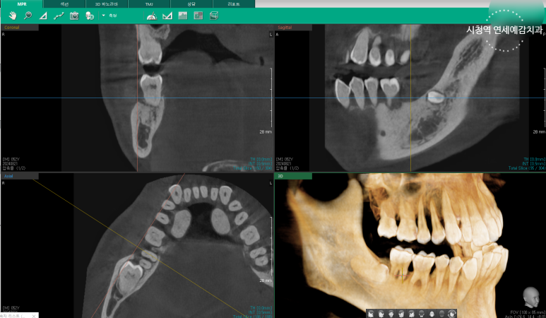 시청역치과 객관적인 근거로 치료하며, 환자분께 치료 전 치료해야하는 이유를 보여드립니다. 관련 이미지 7