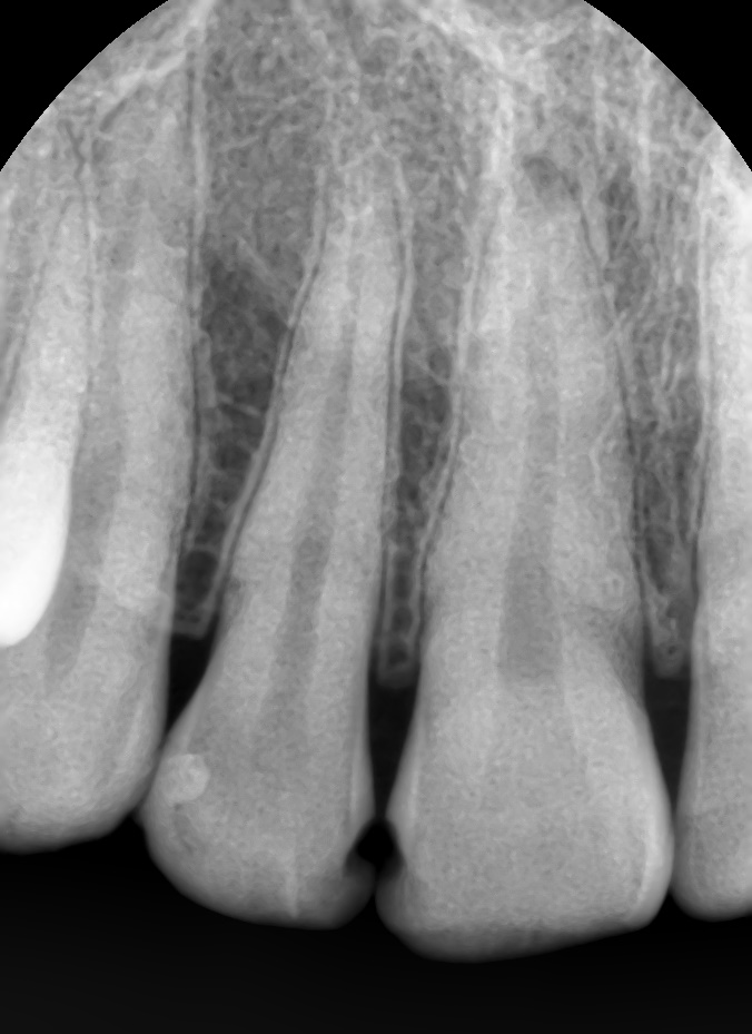 [을지로/명동 근처 치과] 앞니 레진 치료사례 관련 이미지 1