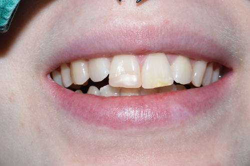 [서울역/을지로/치과] 본인이 옥니라고 생각한다면? 무삭제 라미네이트 어떤가요? 케이스 및 가격비용 관련 이미지 7