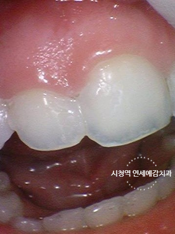 해외에서도 찾아오는 앞니레진치료, 광화문 시청역 서울역 근처 연세예감치과 외국인도 찾는 이유 관련 이미지 4