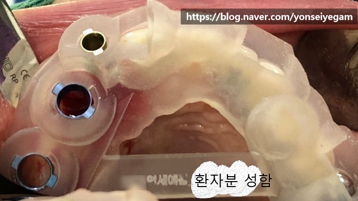 [시청역/서울역]네비게이션인플란트를 이용한 여러개 임플란트 과정 관련 이미지 8