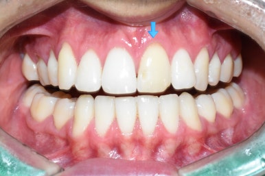 서울 시청역 치과 &ldquo;앞니 하나만 색깔이 달라요&rdquo; 관련 이미지 2