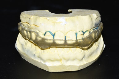 이갈이원인 증가요인 이갈이 치료방법 비용 관련 이미지 6