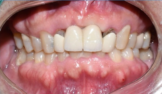 만65세이상 중 의료급여1종 보험임플란트 얼마일까요? 비용안내, 조건안내 관련 이미지 4