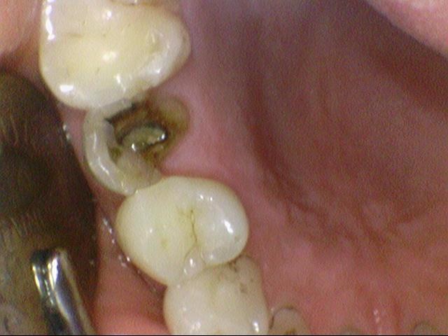 신경치료 끝났는데 크라운 해야하나요? 자연스러운 지르코니아 크라운 유명한 치과 가격까지 관련 이미지 2