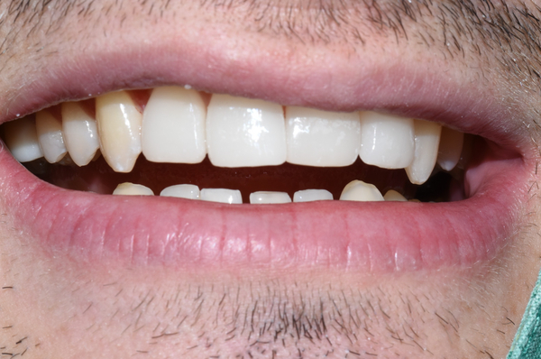 왜소치 치아사이틈 막기 올해는 치료받으세요! [무삭제라미네이트 케이스] 관련 이미지 7