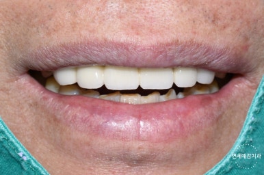 서울시청역 남대문 임플란트 대신에 앞니 브릿지를 한 케이스 관련 이미지 12