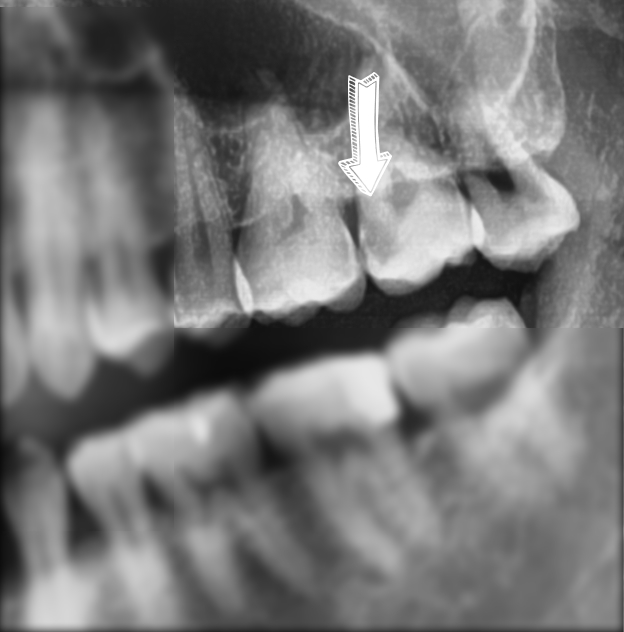 시청역치과 충치치료, 많이 썩었을 때? 신경치료에 대해 알아보아요 관련 이미지 1