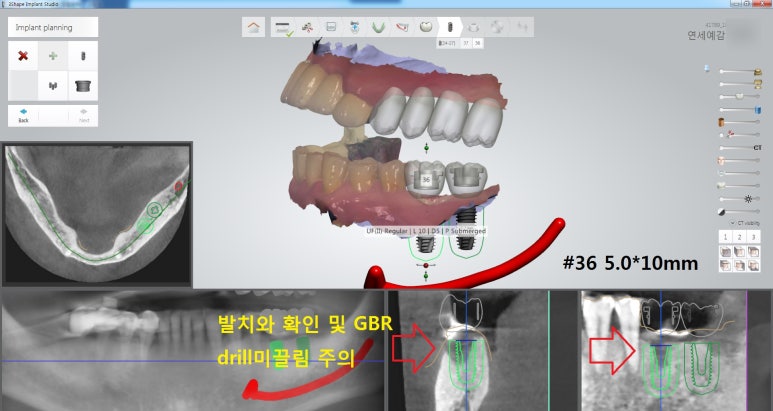 남대문시장 근처 치과 임플란트 연세.예감.치과 관련 이미지 10