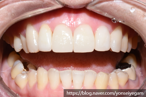 [시청역/광화문/서대문]삐뚤삐뚤한 치아 무삭제라미네이트로 치아성형 관련 이미지 10