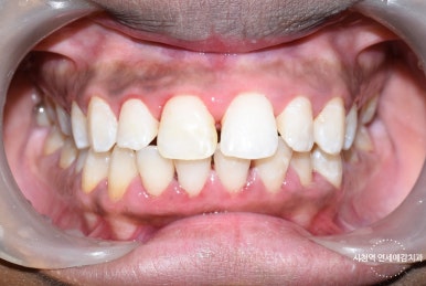 서울시청역 앞니 치아에 갈색 점, 흰색점 치료 전후 관련 이미지 7