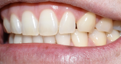 앞니 사이 벌어진 부위 레진치료의 방법 관련 이미지 2